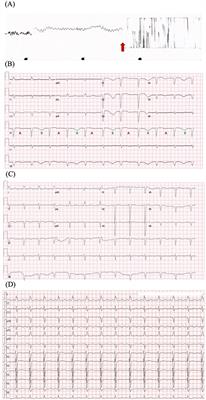 Recurrent ventricular arrhythmias and heart failure induced by osimertinib- a case report